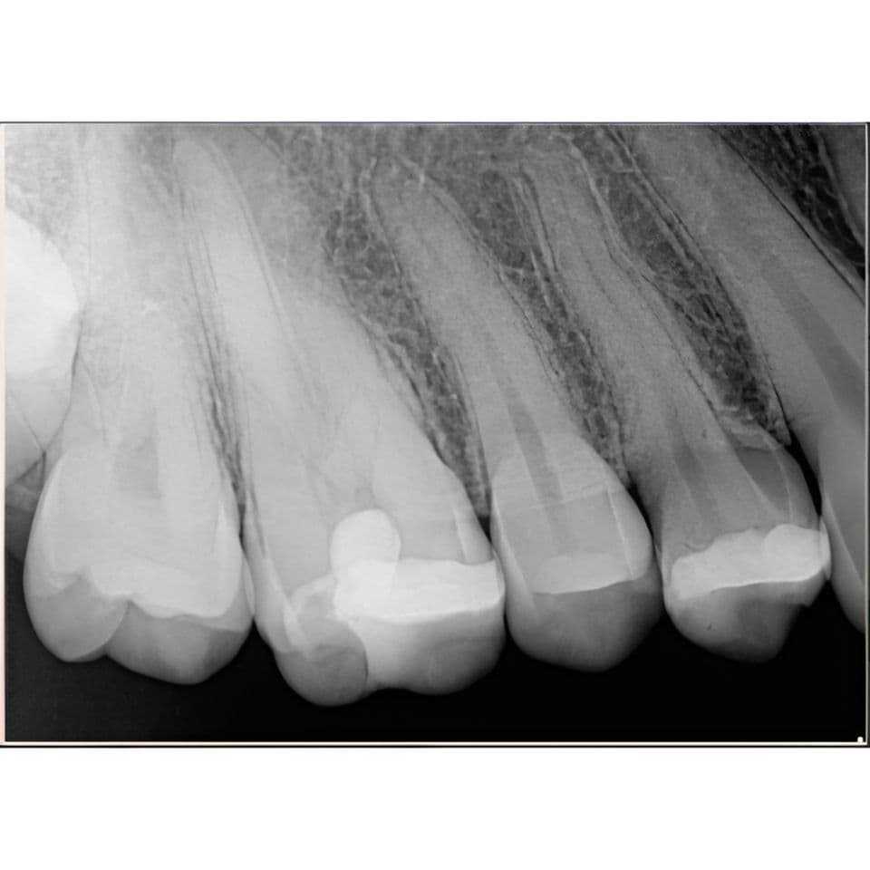 Schick CDR Elite Size 2 Digital Dental Sensors thumbnail 5