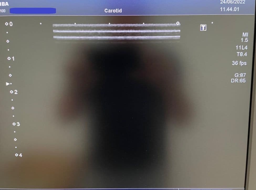 Toshiba PLU-704BT Linear Ultrasound Transducer thumbnail 7