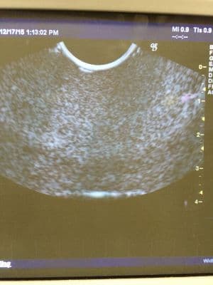 GE E8C Transvaginal Ultrasound Transducer Probe thumbnail 4
