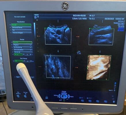 GE RIC5-9W-RS Endocavitary Ultrasound Transducer for Voluson Systems thumbnail 7