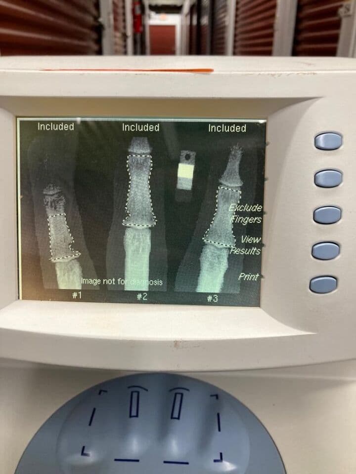 Osteoporosis Screening Bone Densitometer — Alara MetriScan thumbnail 4