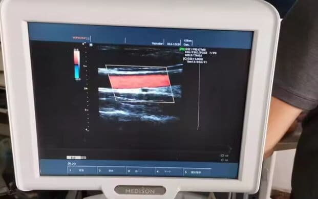 Medison SonoAce X6 Ultrasound System with 3 Probes thumbnail 3