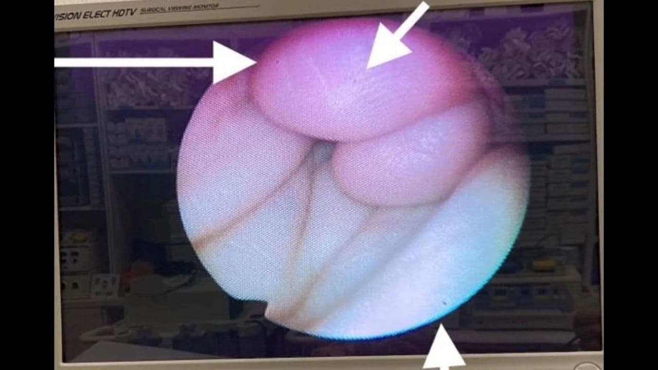 Olympus BF-P60 Fiberoptic Bronchoscope thumbnail 2
