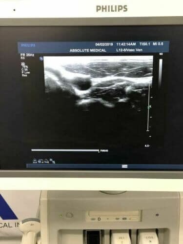 Philips L12-5 Linear Array Ultrasound Transducer Probe thumbnail 4