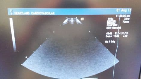 Acuson 7V3c Pediatric Cardiac Ultrasound Transducer thumbnail 3