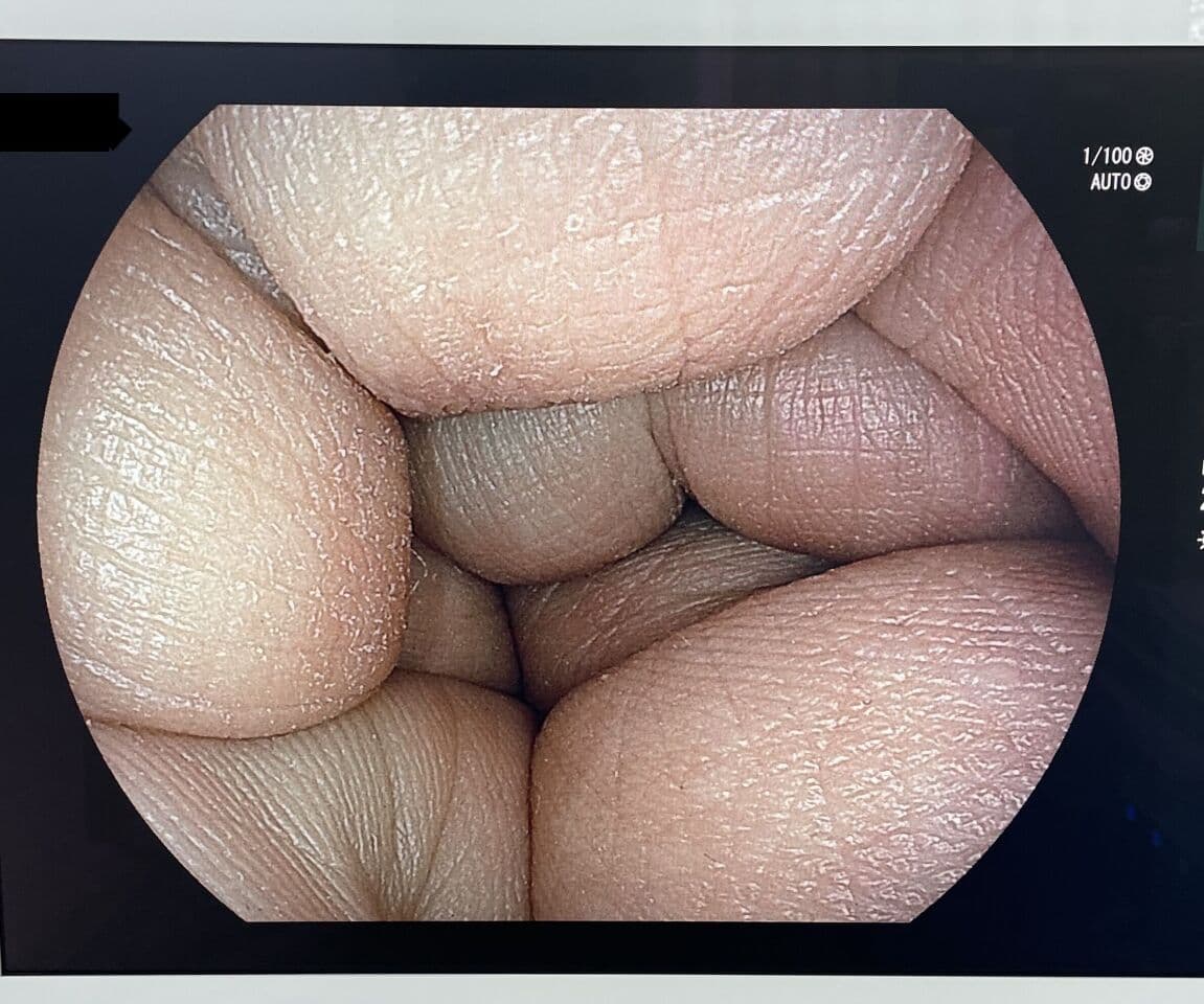 Advanced GI Endoscopy with the Fujinon ELUXEO EP-6000 Video System thumbnail 2