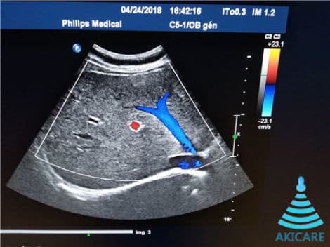 AKICARE C5-1 Convex Ultrasound Probe for Philips Systems thumbnail 3