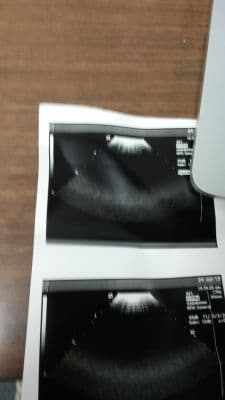 Acuson 4V1 Vector Array Ultrasound Transducer thumbnail 3