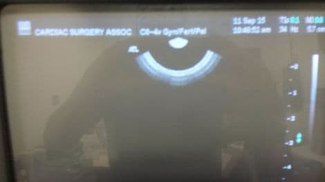 ATL C8-4v Endovaginal Curved Array Ultrasound Transducer thumbnail 2