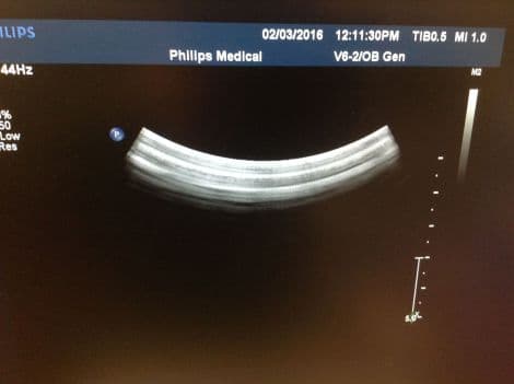 Philips V6-2 Volume Curved Ultrasound Transducer for iU22 & HD11XE Systems thumbnail 3