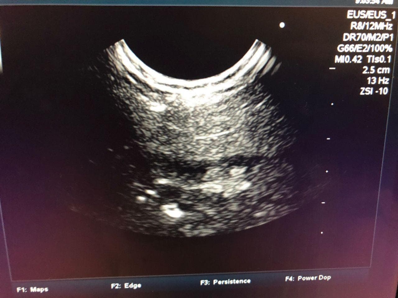 FUJIFILM EG-530UT2 Ultrasound Video Gastroscope for EUS Procedures