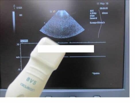 Siemens Acuson 8V5 Cardiac Ultrasound Transducer thumbnail 3