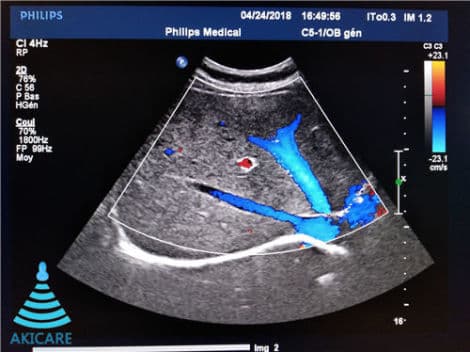 AKICARE C5-1 Convex Ultrasound Probe for Philips Systems thumbnail 4