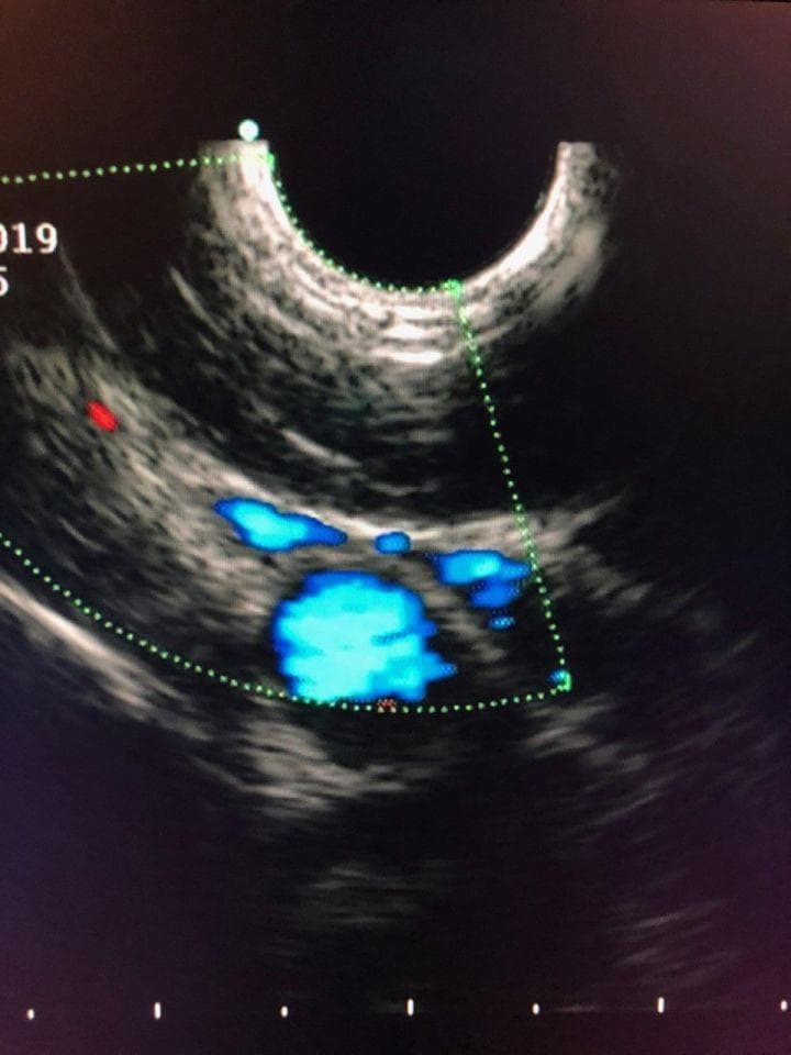 Olympus GF-UCT140-AL5 Linear Ultrasound Gastroscope for EUS Procedures thumbnail 3