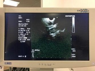 OLYMPUS GF-UCT140-AL5 Ultrasound Gastroscope for EUS Procedures thumbnail 6
