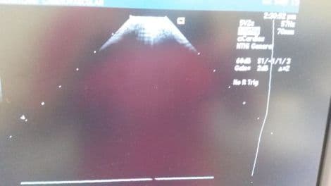 Acuson 5v2c Cardiac Ultrasound Transducer for Sequoia Systems thumbnail 4