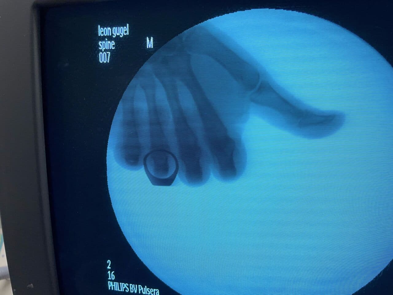Philips BV Pulsera Digital Mobile C-Arm System thumbnail 2