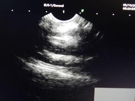 FUJINON EG-530UT Endoscopic Ultrasound (EUS) Gastroscope thumbnail 3