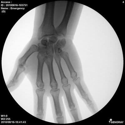 Genoray New Zen 7000 Mobile C-Arm Fluoroscopy System thumbnail 3