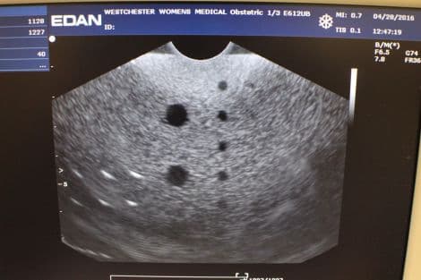Edan E612UB Transvaginal Ultrasound Transducer for U50 Systems thumbnail 3