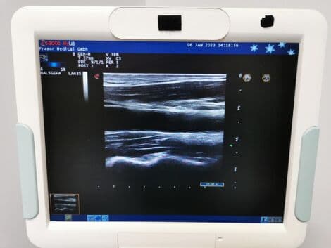 General Ultrasound System by Esaote — Mylab 60 with LA435, LA522E, and CA631 Probes thumbnail 6