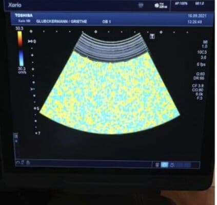 Toshiba PVU-674BT Convex Ultrasound Transducer thumbnail 5
