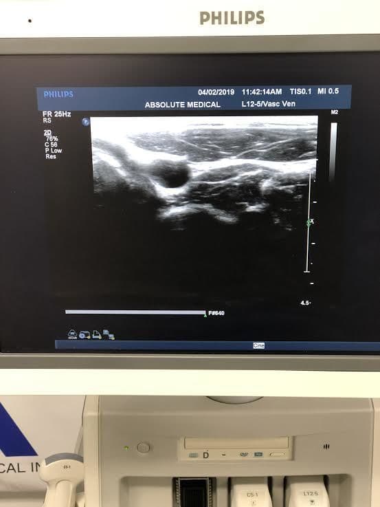 Philips L12-5 Linear Array Vascular Ultrasound Transducer Probe thumbnail 2