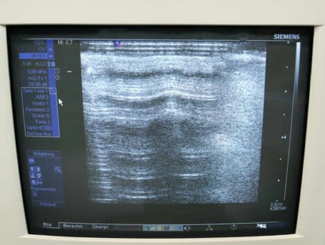 Vascular Imaging Linear Ultrasound Transducer — Siemens VF13-5 thumbnail 3