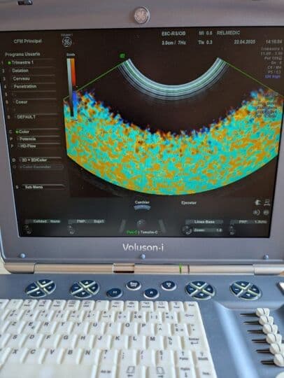 GE Voluson i Portable OB/GYN Ultrasound System thumbnail 10