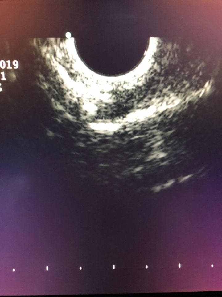 Olympus GF-UCT140-AL5 Linear Ultrasound Gastroscope for EUS Procedures thumbnail 2