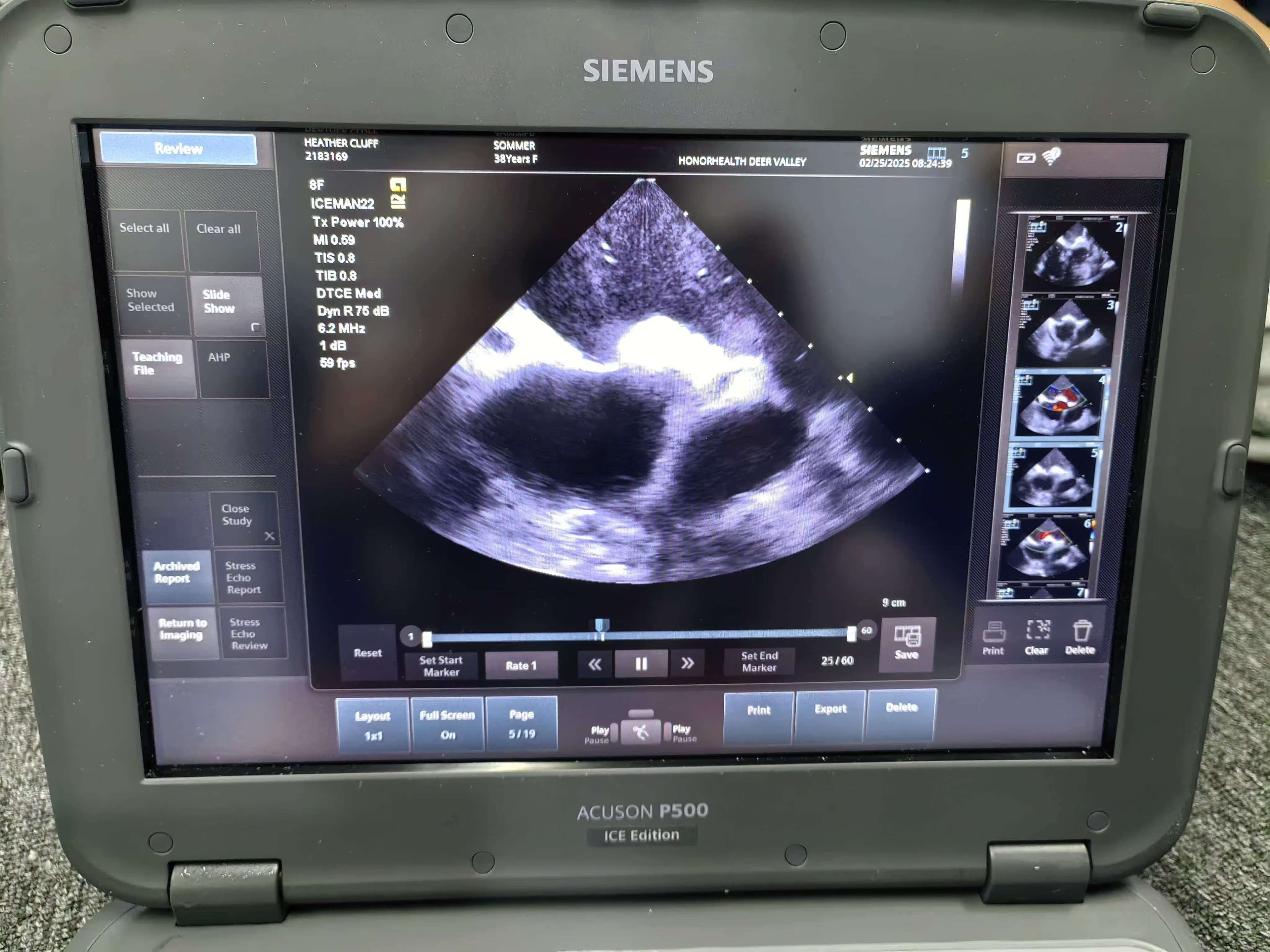 Siemens P500 | ACUSON P500 Ultrasound | 2019 YOM Used Portable Color Doppler | Siemens Laptop Ultrasound Without Probes | Point-of-Care Emergency Scanner Gantry thumbnail 5