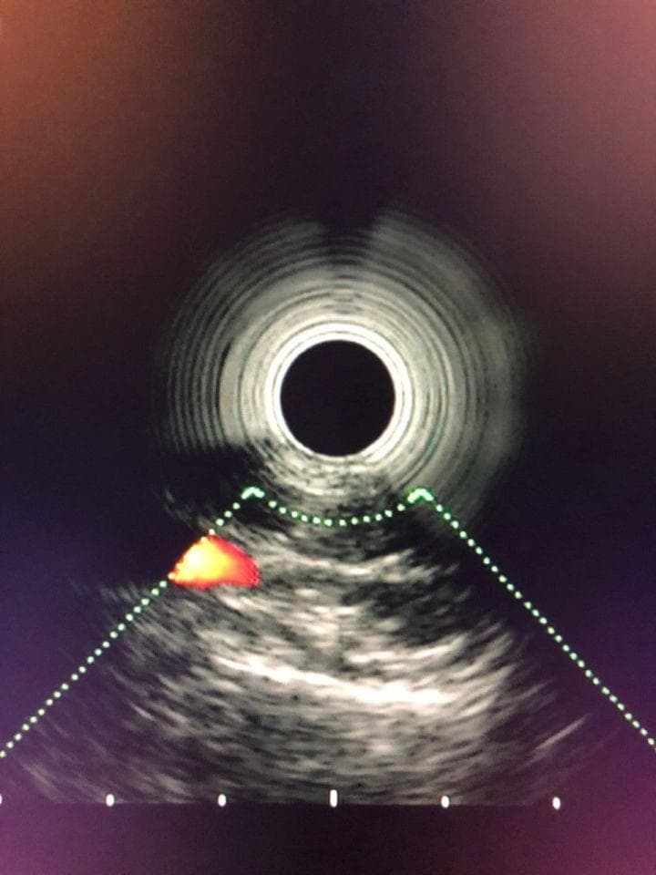 OLYMPUS GF-UE160-AL5 Radial Scanning Ultrasound Gastroscope thumbnail 2