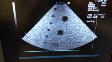 Acuson 7V3c Pediatric Cardiac Ultrasound Transducer thumbnail 4