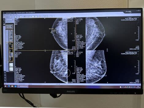 Digital Breast Imaging with the Hologic Selenia Mammography Unit thumbnail 7