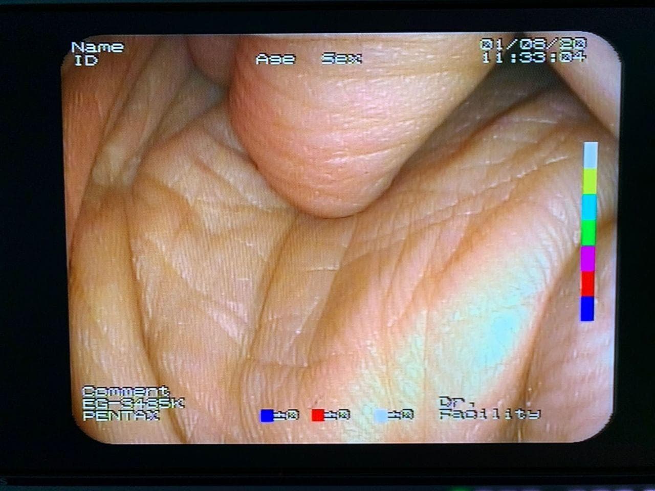PENTAX EG-3485K Video Gastroscope for Upper GI Endoscopy thumbnail 3