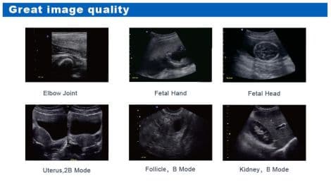 Portable B/W Ultrasound System — Chison ECO1 thumbnail 3