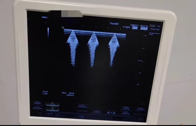 Hitachi Avius ultrasound machine repair (RDBF beamformer board) Artifact Imaging thumbnail 3
