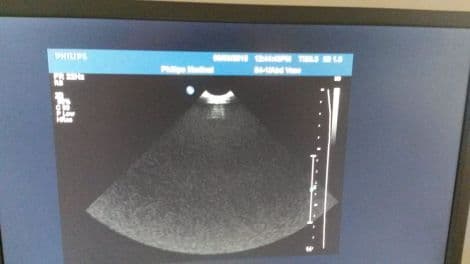 Philips S4-1 Sector Ultrasound Transducer for iU22 Systems thumbnail 3