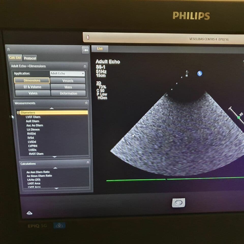 Refurbished Philips Epiq 5G PureWave Ultrasound System thumbnail 5