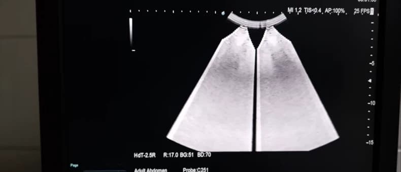 Hitachi ARIETTA 60 RDBF Board Repair Service (EP576200 – Image Noise / Artifact / Abnormal Imaging)