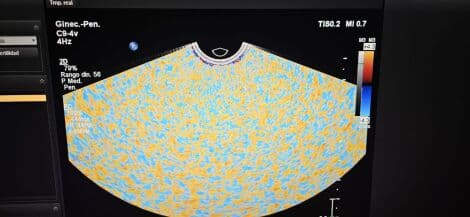 Philips C9-4V Intracavitary Ultrasound Transducer thumbnail 5