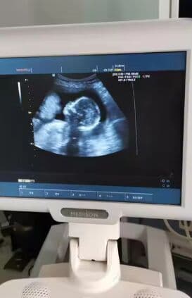 Medison SonoAce X6 Ultrasound System with 3 Probes thumbnail 2