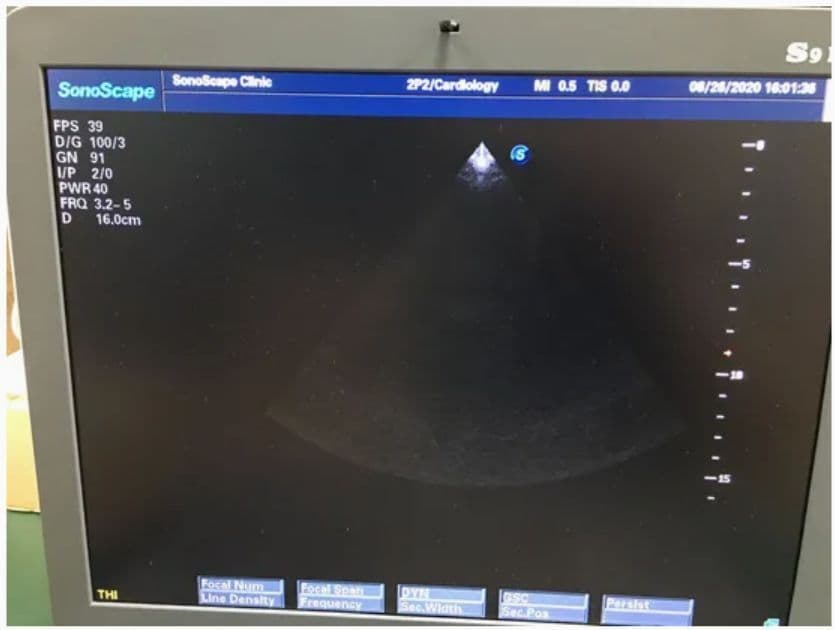 SonoScape 2P2 Phased Array Ultrasound Transducer
