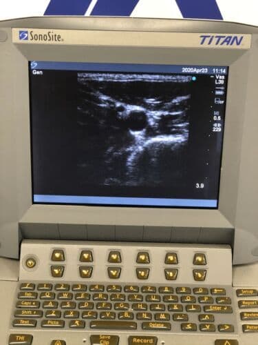 SonoSite TITAN Portable Ultrasound System with L38 Linear Array Probe thumbnail 4