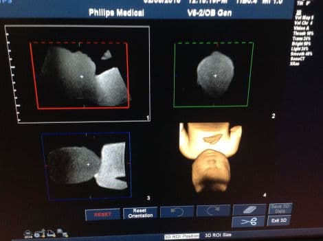 Philips V6-2 Volume Curved Ultrasound Transducer for iU22 & HD11XE Systems thumbnail 4