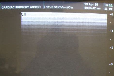 ATL L12-5 Linear Ultrasound Transducer for Small Parts and Vascular Applications thumbnail 2