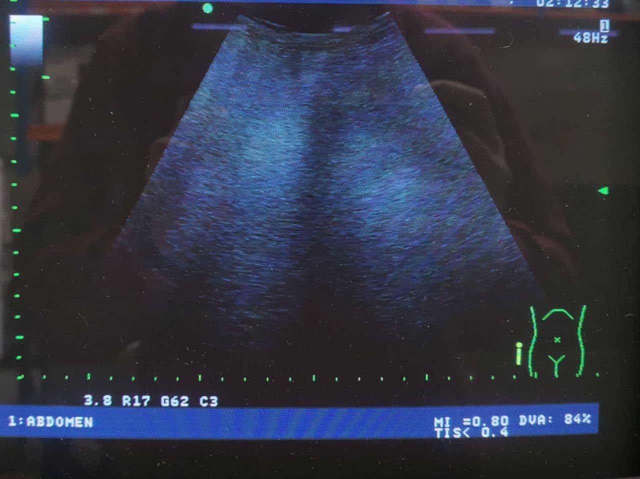 Ultrasound Transducer — Aloka UST-9126 thumbnail 8
