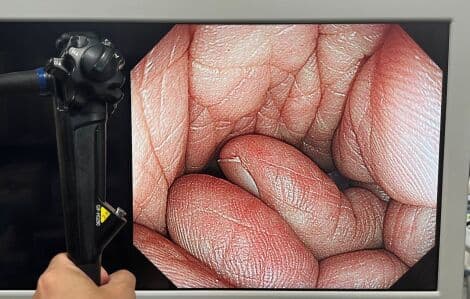 High-Definition Gastroscopy with the Olympus GIF-HQ290 Video Gastroscope thumbnail 3