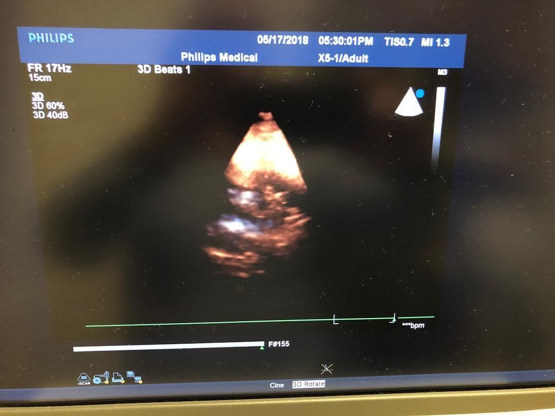 Philips X5-1 X-Matrix Phased Array Ultrasound Transducer thumbnail 3