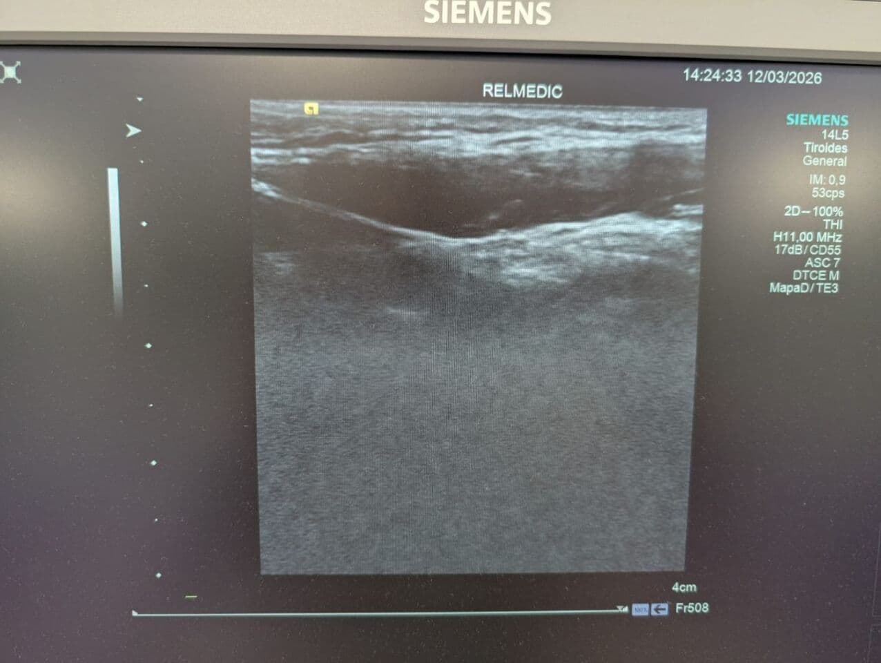 Siemens 14L5 Linear Ultrasound Transducer thumbnail 8